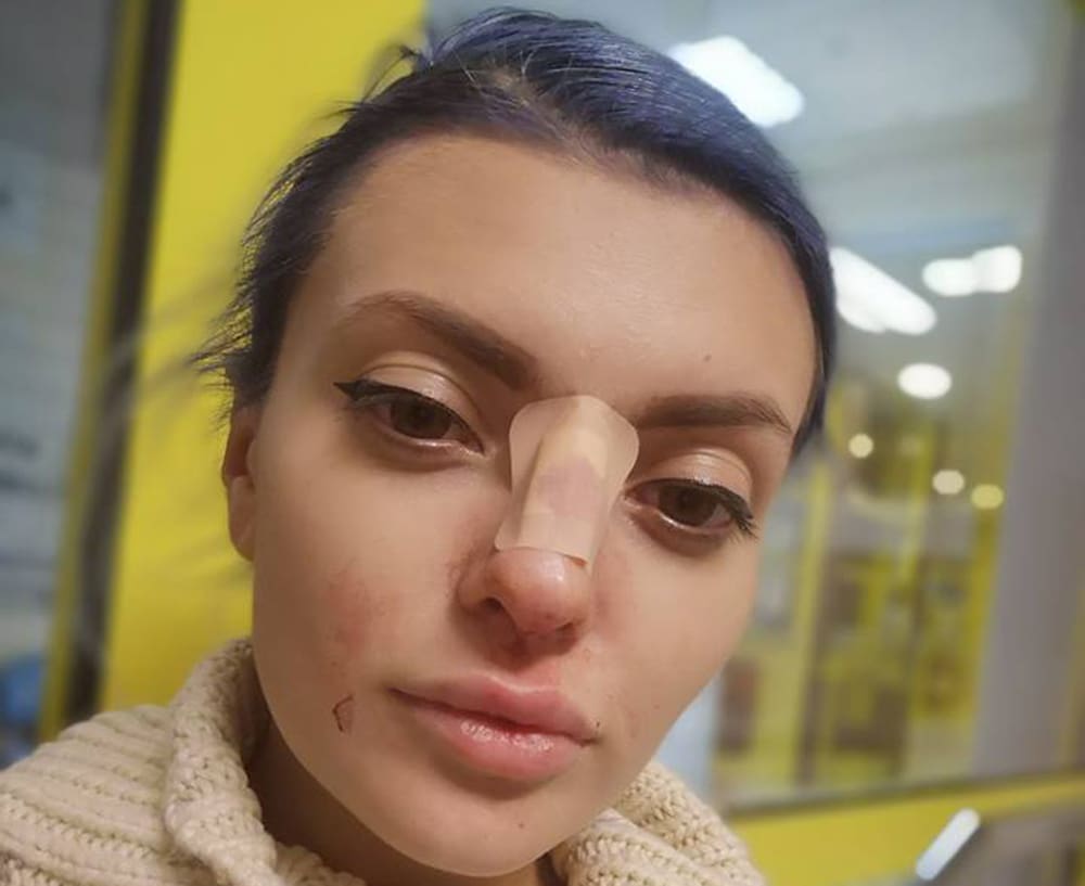 Ella Dvornik iznenadila obožavatelje fotografijom krvavog nosa