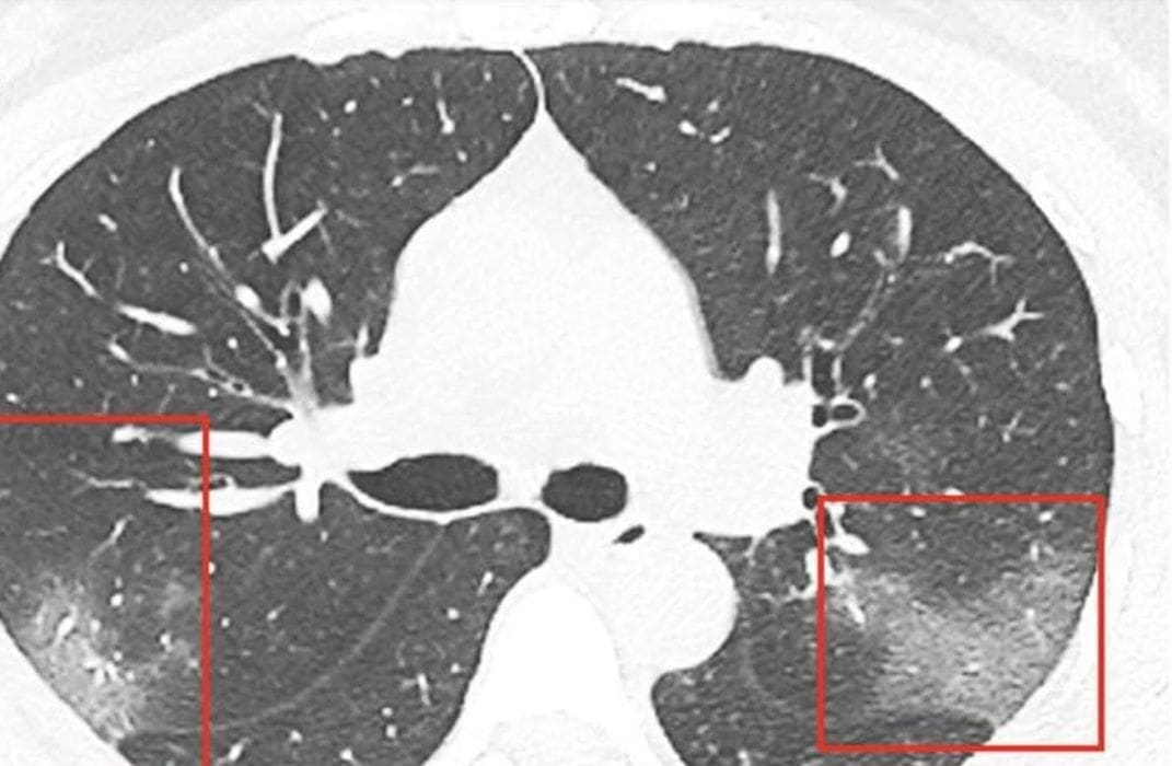 Predstavljena CT snimka; Liječnici pokazali kako koronavirus djeluje na ljudska pluća