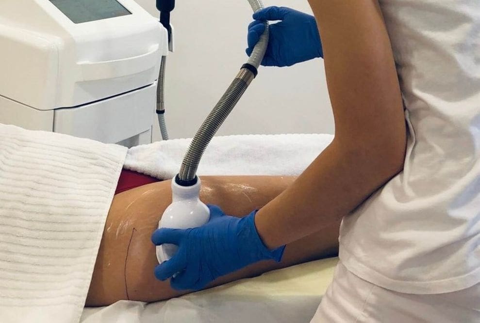 Inovativna revolucija za brzo uklanjanje masnih naslaga i zatezanje kože - novi CRYO SONIC