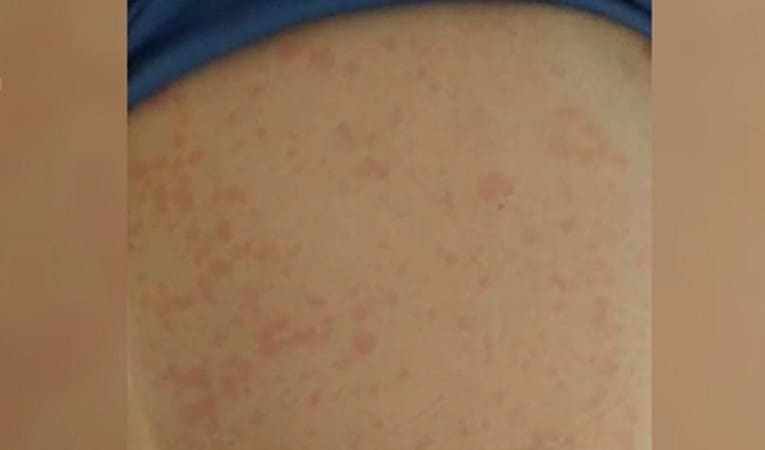 Majka iz Pule: Sin mi je prehodao koronu. Onda je dobio osip, oči su mu otekle