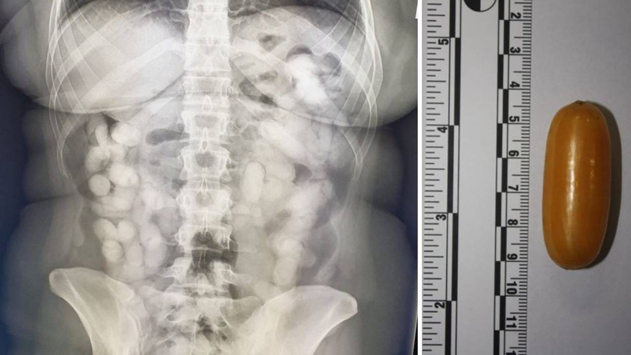 NEVJEROJATAN PRIZOR Ovo je rengden Brazilke koja je progutala gotovo kilogram kokaina