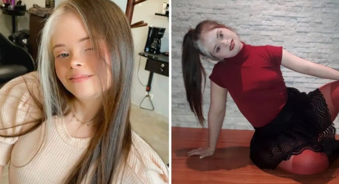 Ima Downov sindrom, ali to je nije spriječilo da postane model