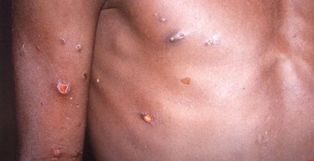 U BiH je 2022. zabilježeno devet slučajeva majmunskih boginja, a od tada niti jedan