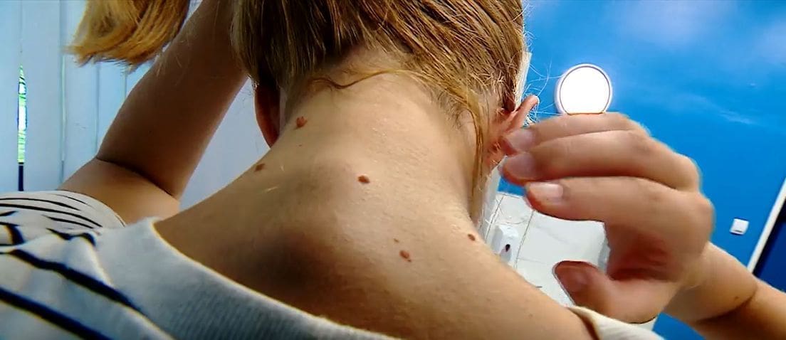 RH JE NA VRHU PO SMRTNOSTI Liječnici će uskoro pozivati na pregled kože, evo tko će prvi biti na popisu