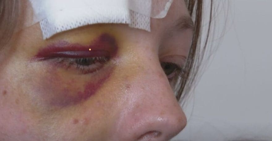 UŽAS! Najmodavac istukao bivšu podstanarku zbog pologa: "Da me nije bilo, tukao bi je do smrti"