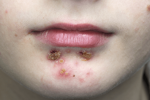 impetigo