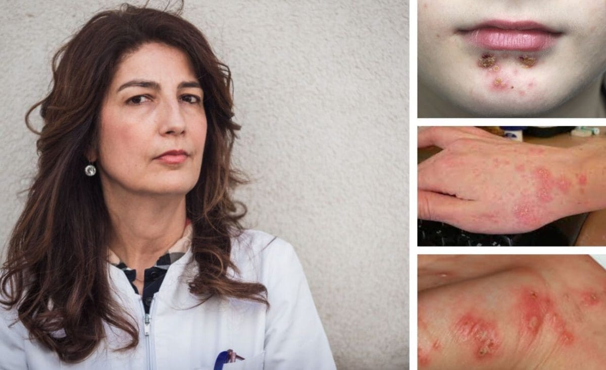 'DRAGI RODITELJI, POJAVILI SU SE SVRAB, SLATKE KRASTE, ...' Splitska epidemiologinja: "Danas kada imamo doktora Googlea i društvene mreže, daje se prevelika važnost nekim stvarima koje uistinu ne bi trebale biti toliko važne"