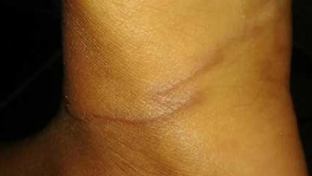 Liječnici šokirani ovim slučajem, dječaku se na stopalima pojavile neobične linije