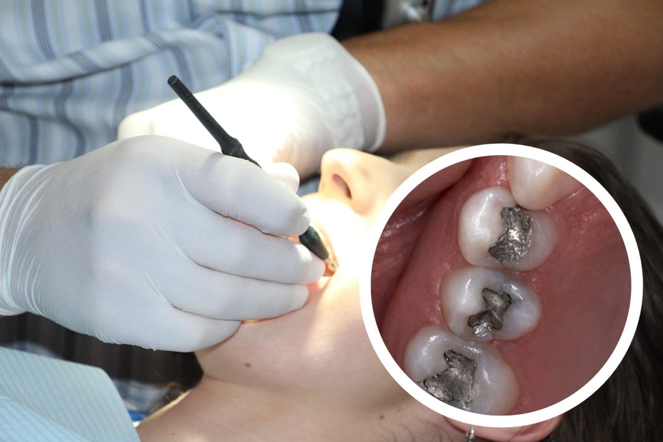 Hrvatska zabranjuje "crne plombe" u zubima. Što ako ih još uvijek imate u ustima?