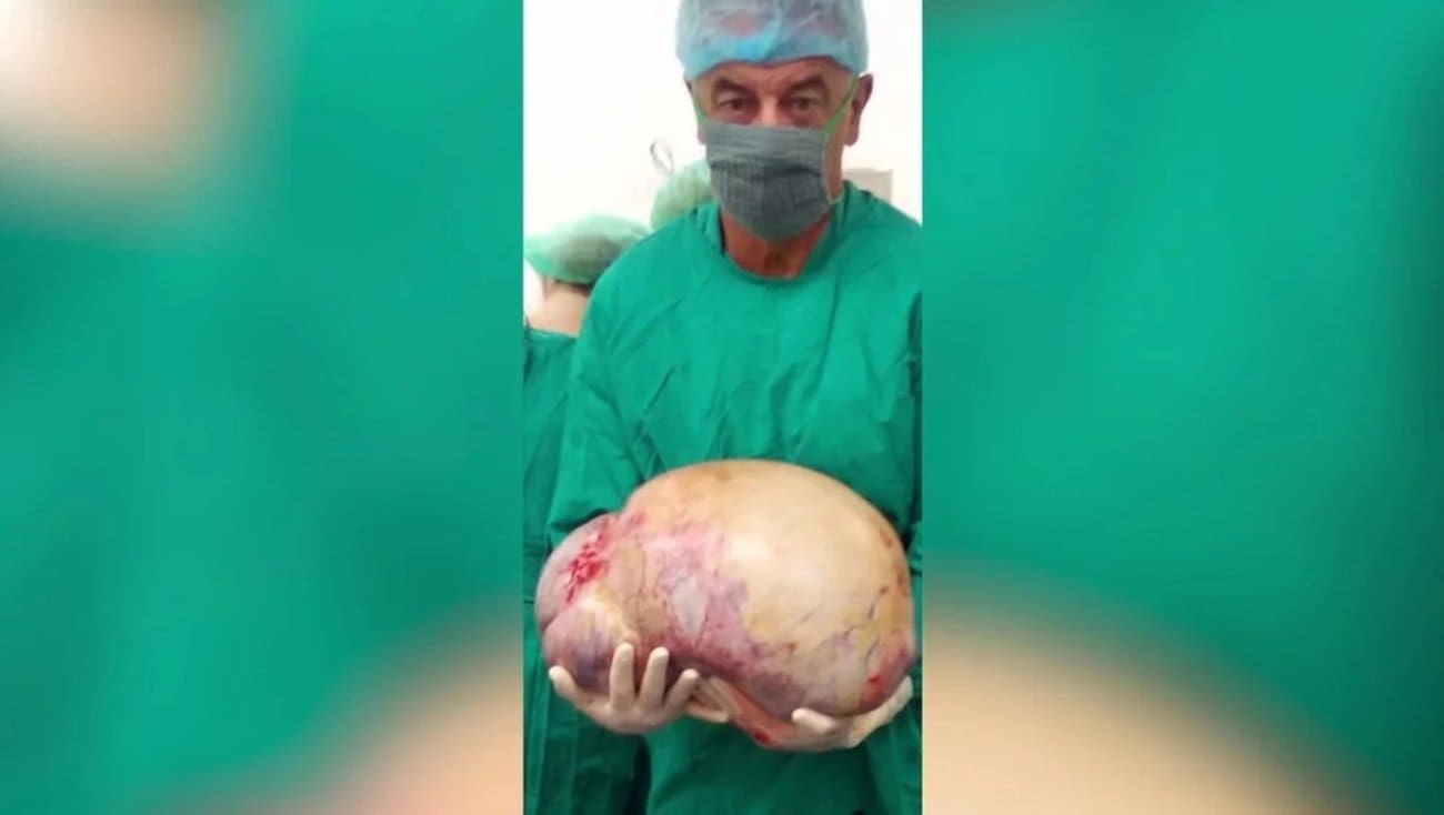 Operiran najveći tumor u Hrvatskoj. "36 kilograma lakša za četiri sata, potpuno je ispunjavao trbušnu šupljinu"