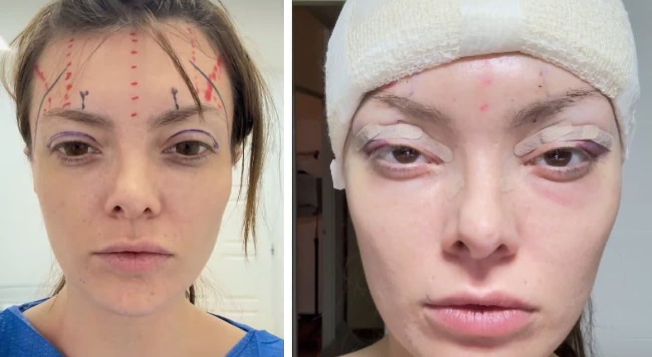 VIDEO Ella Dvornik o novoj operaciji: "Zaklamali su mi glavu"