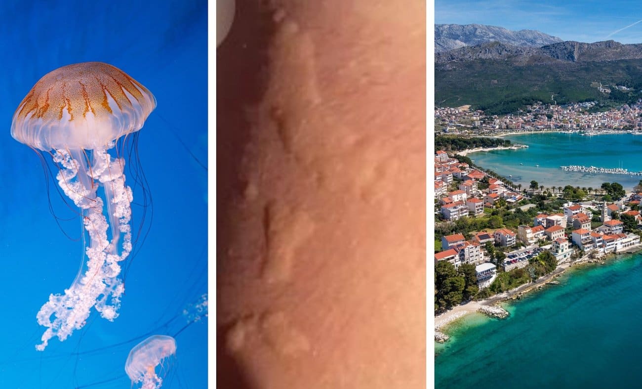 Kupanje kod Splita nije završilo dobro: "Počelo nas je strašno peći, jednom je stradalo područje oko očiju"